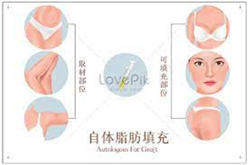 自体脂肪填充图