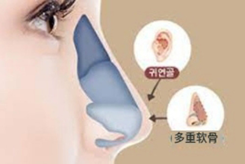 自体软骨隆鼻示意图