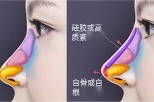 假体隆鼻示意图