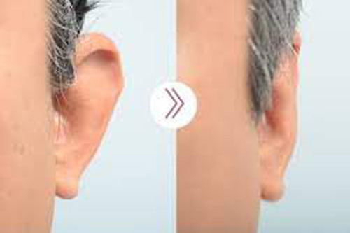 耳部整形对比图