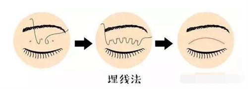 埋线双眼皮图