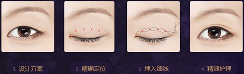 埋线双眼皮示意图