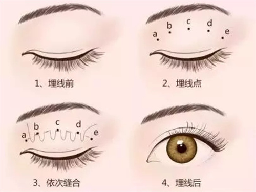 埋线双眼皮图
