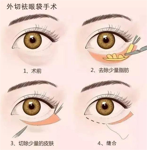 祛眼袋手术过程图