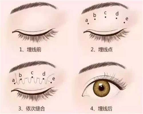 埋线双眼皮过程图