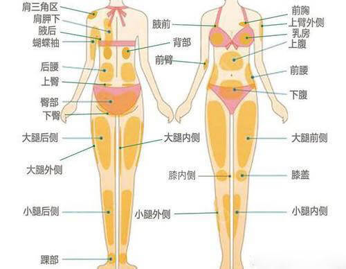 全身吸脂部位示意图