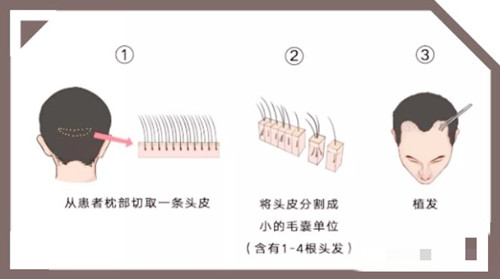 植发毛囊提取图示
