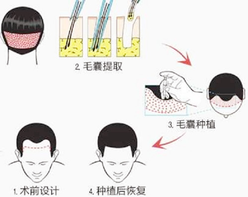 头发种植过程图示
