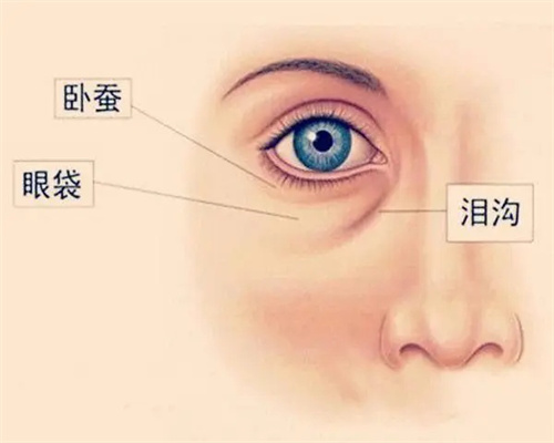眼袋与泪沟对比图