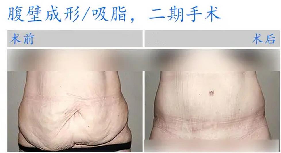 腹壁整形手术术前术后对比图