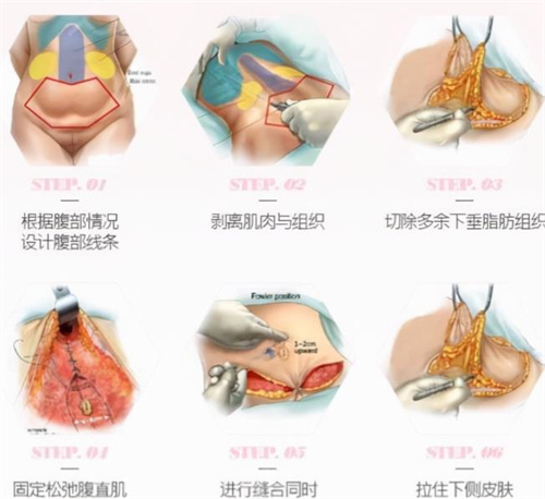 腹壁整形手术操作图
