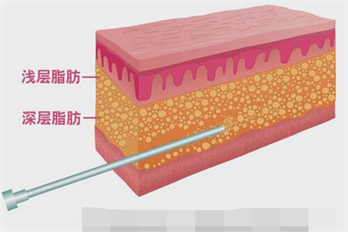 吸脂手术抽吸脂肪层次展示图