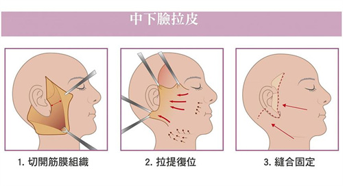 拉皮图