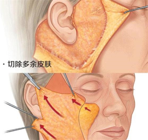 拉皮操作图