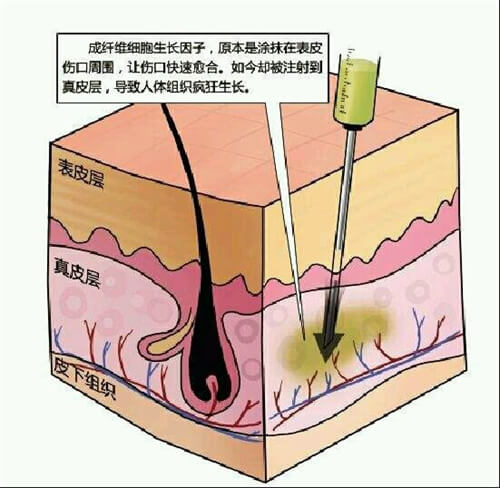 生长因子面部注射层次漫画示意图