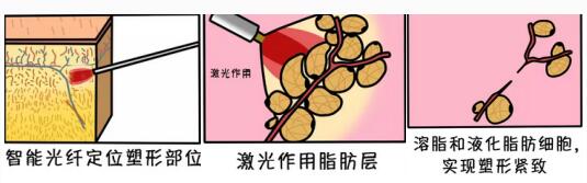 光纤溶脂步骤漫画图