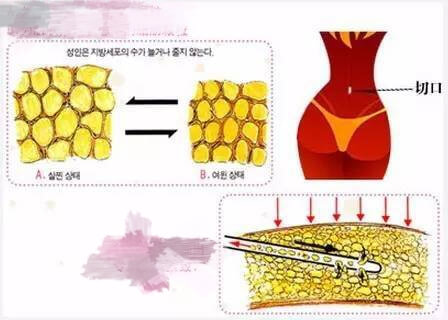 吸脂手术切口及脂肪示意图