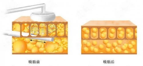 吸脂前后脂肪层对比