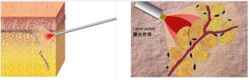 黄金微雕作用示意图