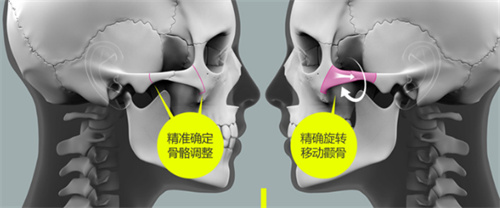 颧骨手术示意图 颧骨手术示意图