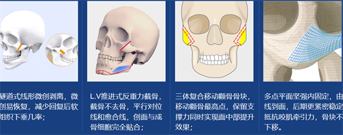 颌面磨骨示意图 颌面磨骨示意图