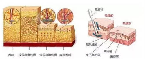 吸脂前后脂肪变化示意图