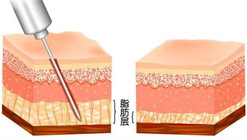 吸脂手术前后脂肪层漫画示意图