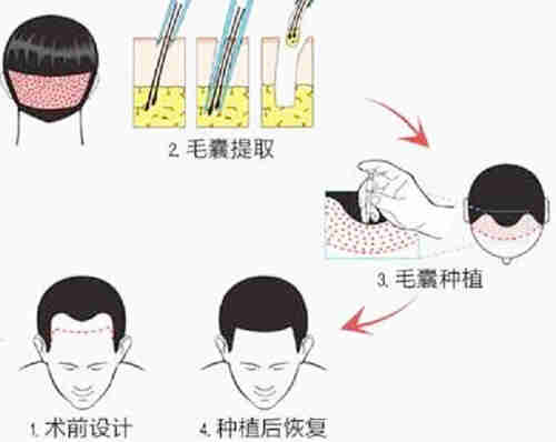 植发手术过程图示