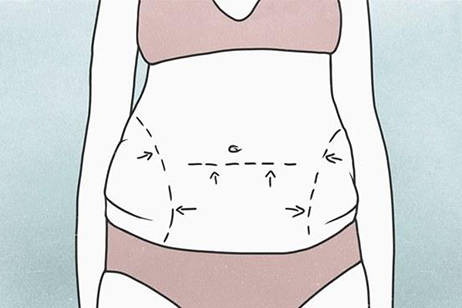 腰腹吸脂设计划线漫画图