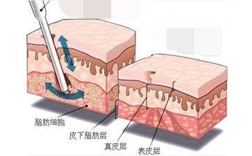 吸脂脂肪层部位示意图