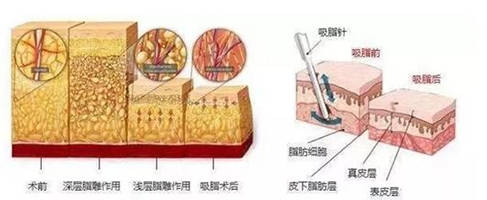 吸脂术前术后脂肪层变化示意图