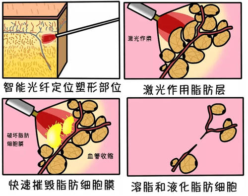 光纤溶脂过程漫画图