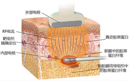 黄金微雕原理示意图