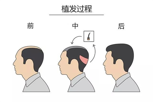植发过程图卡通图