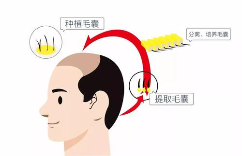 植发过程图示意图