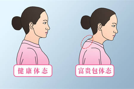健康体态跟富贵包体态对比