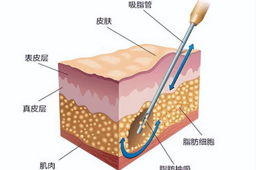 吸脂脂肪层次示意图
