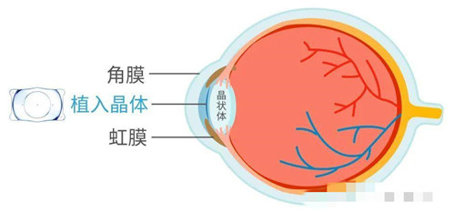 近视眼图示