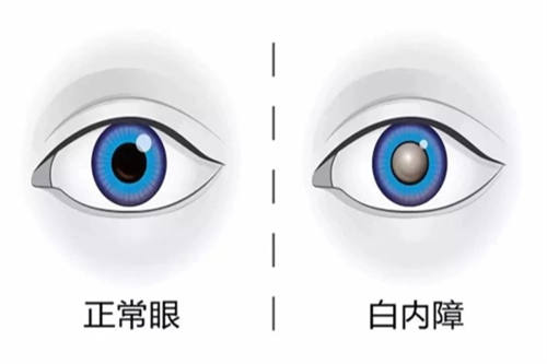 白内障漫画对比图