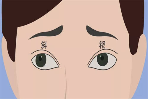 斜视示意图