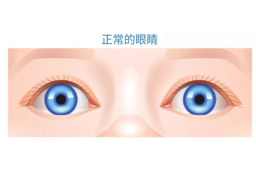 正常眼镜图