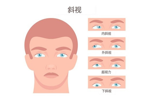斜视对比图