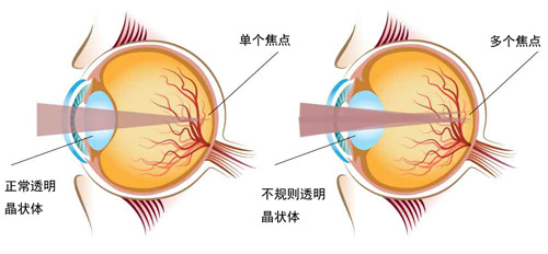 正常眼球和散光眼球对比