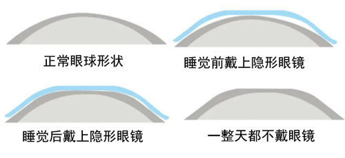 佩戴角膜塑形镜步骤