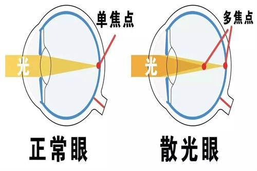 散光眼对比图