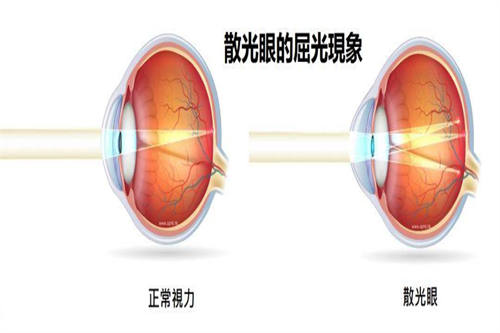 散光眼屈光图