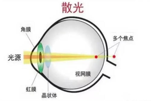 散光眼示意图