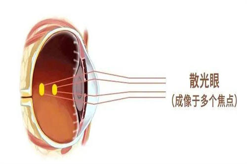 散光眼细节图