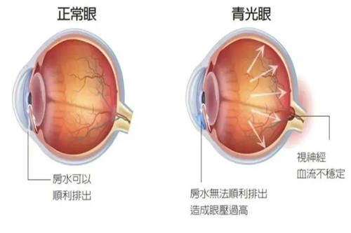 青光眼对比图