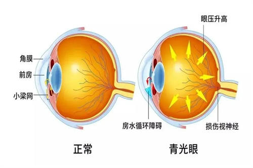 青光眼模型对比图